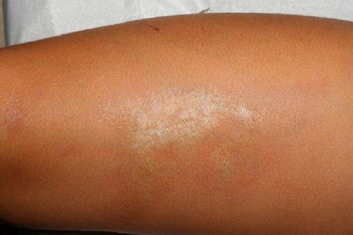 بیماری پوستی مورفه آ چیست؟